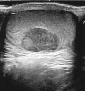 Tumore del Testicolo